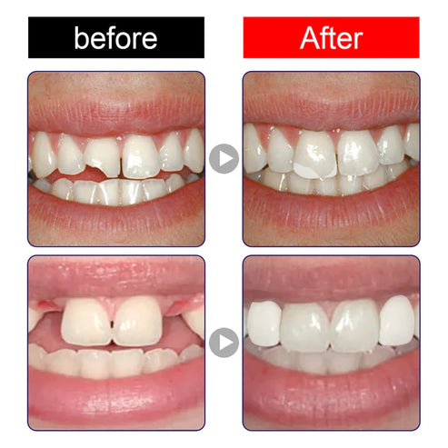 Repara tu Sonrisa en Minutos: Prótesis Instantánea sin Visitas al Dentista